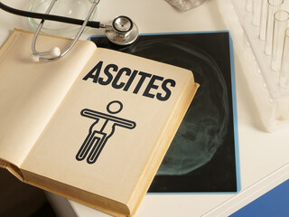 Ascites is shown using the text and picture