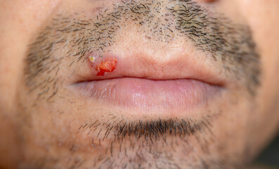 close up of a man with herpes on the lips Caused by a weak immune system