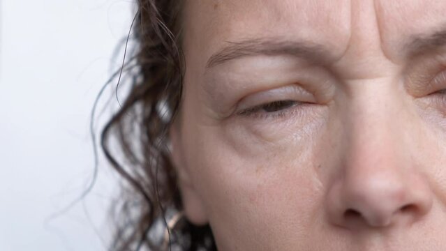 Swelling in the eyes. An adult woman suffers from eye allergies.