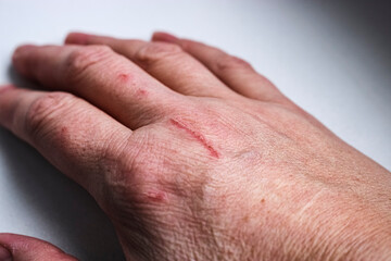 Hand scratched by a kitten. The dangers of cat scratch disease. Selective Focus