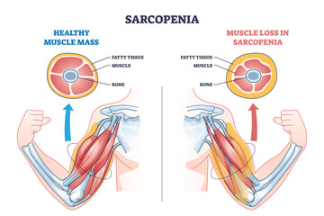 Sarcopenia as muscle mass loss and fatty tissue growth outline diagram, transparent background. Labeled educational medical scheme with aging caused weakness and muscular pathology illustration.