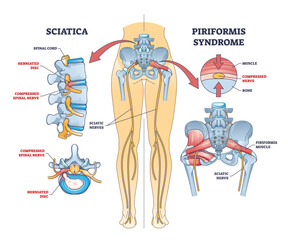 Sciatica vs piriformis medical muscle conditions comparison outline diagram, transparent background. Labeled educational scheme with hip anatomy and compressed nerve.
