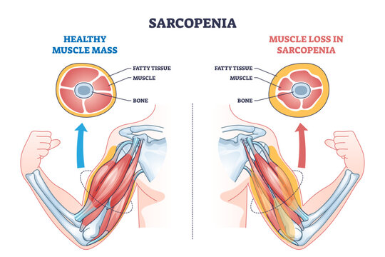Naklejki Sarcopenia as muscle mass loss and fatty tissue growth outline diagram, transparent background. Labeled educational medical scheme with aging caused weakness and muscular pathology illustration.