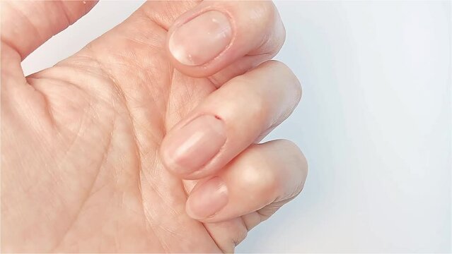 Injury due to careless cutting of the cuticle in the process of an unprofessional manicure at home. A drop of blood on the skin near the nail