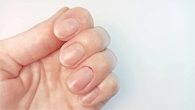 A woman shows a cuticle cut with bleeding. Injuries in the process of unprofessional traumatic manicure and cuticle cutting