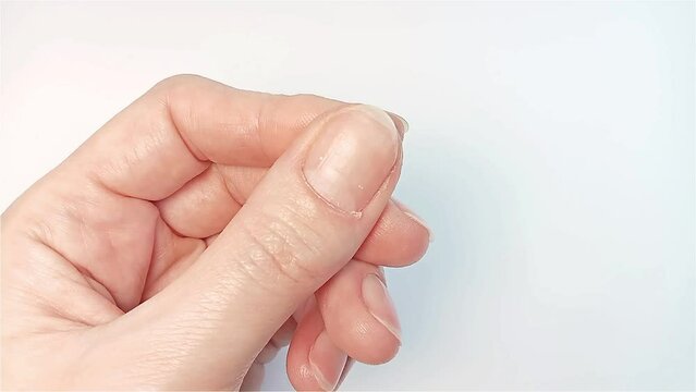 Hangnail, white spots, and ridged nail problems. A woman shows a thumbnail with a burr-damaged cuticle. Hand skin care and nail treatment concept