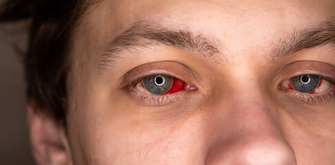 Bloodshot Eye with Red Veins. Broken Blood Vessels. Sore, Inflamed Eyeballs Close up.