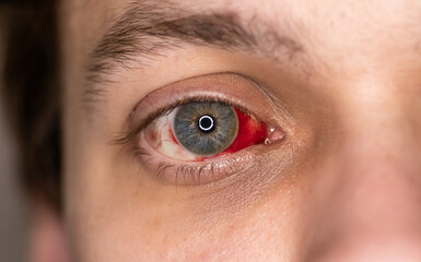 Bloodshot human eye with noticeable subconjunctival hemorrhage. Blood in eyeball, close up.
