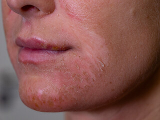 CLOSE UP, DOF: Lady with a damaged epidermis and reddened flaky facial skin. Peeled skin on face of a young woman with signs of severe inflammation and allergic reaction to dangerous sun exposure.