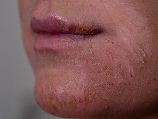 CLOSE UP, DOF: Facial skin of a young woman showing signs of severe inflammation. Lady with a...