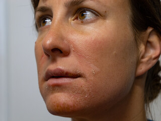 CLOSE UP, PORTRAIT: Young woman with severe sunburns on her face after sunbathing. Careless lady...