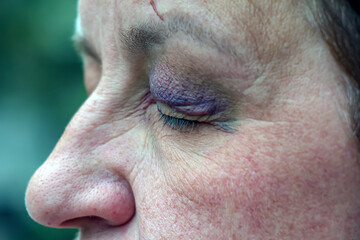 A human eye with a large black-violet bruise. Swelling due to bruise