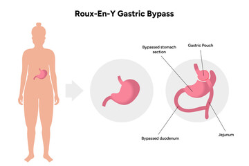 Roux-en-y gastric bypass