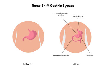 Roux-en-y gastric bypass