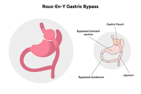 Roux-en-y gastric bypass