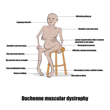 Duchenne muscular dystrophy, an inherited disorder characterized by progressive muscle weakness.