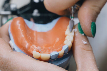 Dentist hand mills tooth crowns.