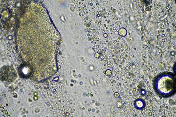 Coughing up mucus and phlegm from a chest infection from a virus and bacteria infection, looking at it under the microscope, with cells and microorganisms. Bacteria and skin cells