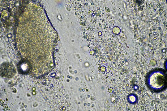 Coughing up mucus and phlegm from a chest infection from a virus and bacteria infection, looking at it under the microscope, with cells and microorganisms. Bacteria and skin cells
