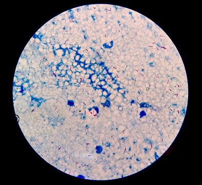 Microscopic 100x image of AFB stainig. Microbacterium Tuberculosis Bacteria (MTB). Sputum or phlegm smear, increase contrast.