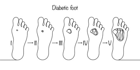 Stages of diabetic foot - obrazy, fototapety, plakaty