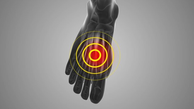 Extensor digitorum longus tendon discomfort that trigger pain