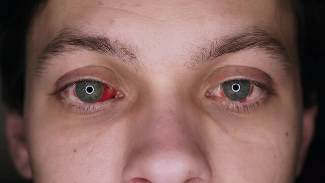 Bloodshot Eye with Red Veins. Broken Blood Vessels. Sore, Inflamed Eyeballs Close up.