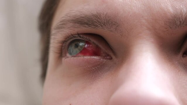 Bloodshot human eye with noticeable subconjunctival hemorrhage. Blood in eyeball, close up.