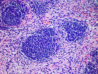 Microscopic Image of a Wilms Tumor or Nephroblastoma of a Childs Kidney Viewed at 200x Magnification with Hematoxylin and Eosin Staining.One of the most Common Cancers Affecting Children.