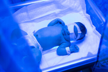 A newborn baby lies under ultraviolet lamps, under blue light. High bilirubin, treatment of...