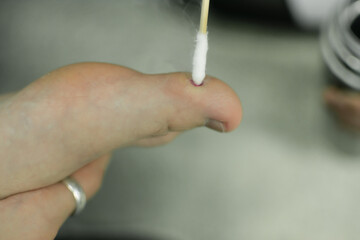 A dermatologist treats a wart with liquid nitrogen on a patient’s leg. skin lesions
