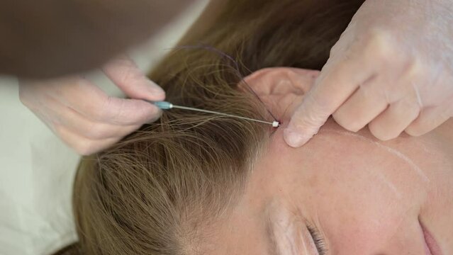 A thread facelift as an alternative to traditional facelift surgery