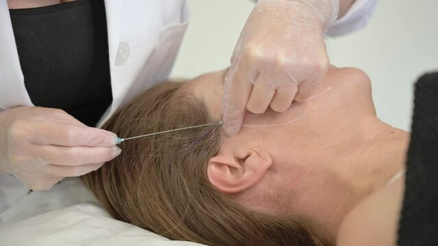 A thread facelift as an alternative to traditional facelift surgery