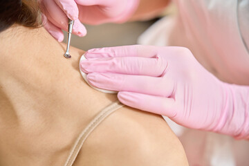 Beauty therapist performing mechanical comedo extraction on adult client
