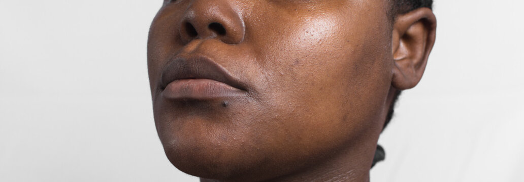 dull brown skin with dark spots, hyperpigmentation on brown skin, african american woman with skin blemishes and texture