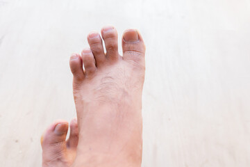 Male foot with shortest fourth toe. Brachymetatarsia Morton's foot, Greek foot, royal toe, peacock toe, Sheppard's toe, Viking toe, Morton's syndrome, long toe or boss toe.