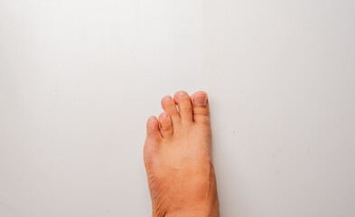 close up of a foot of a man with brachymetatarsia or Morton's foot, a condition in which there is abnormal shortening of one or more metatarsals on a white background,  - obrazy, fototapety, plakaty