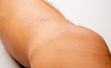 Close up of a man's leg, with post-operative knee incision scars from an anterior cruciate ligament...