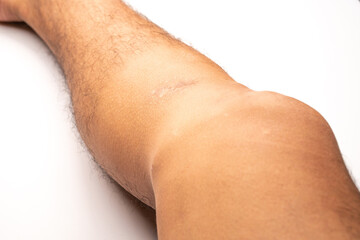 Close up of a man's leg, with post-operative knee incision scars from an anterior cruciate ligament...