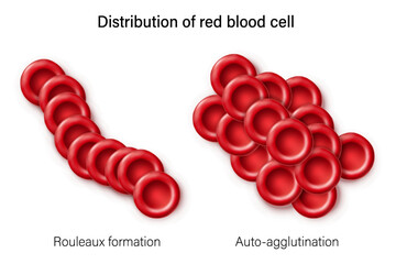 Distribution of red blood cell. Auto-agglutination and Rouleaux formation. Red blood cell morphology. 