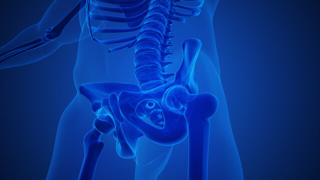 Skeleton With Osteoarthritis Hip Joint Injury