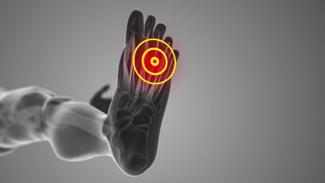 Plantar fascia discomfort that trigger pain