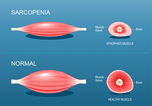 Sarcopenia. Age-related muscle atrophy.