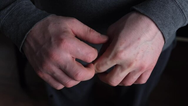 Men's hands scratch one another, a disease of the skin of the hands. Scabies, bitten by parasites or mosquitoes. Itchy hands