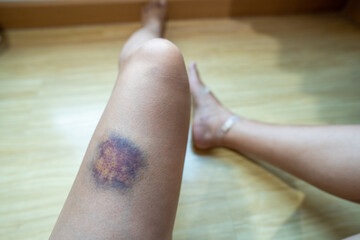 Bruises on women's legs, accident.