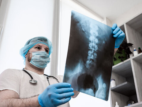 The doctor diagnoses scoliosis in a man on a scan, analyzes the disease of the human spine. Traumatologist vertebrologist with x-ray of the back of the spine of a man. Therapy of osteochondrosis