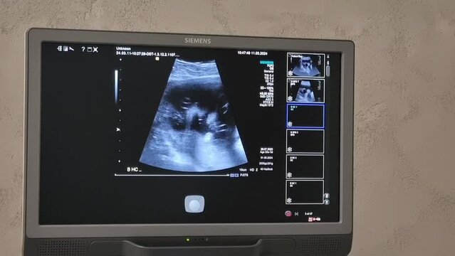 ultrasound monitor with fetus pictures, ultrasound equipment with baby pictures, medical examination of the body of the pregnant woman patient, new life embryo 