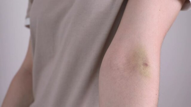 Closeup Female Person Hand With Hematoma, Bruise After Injection, Blood Sampling On Gray Background. Injury, Post-injection phlebitis. Horizontal plane.