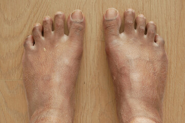Closeup view of dry human feet skin .