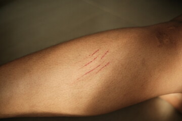 Scratches on the skin on the legs